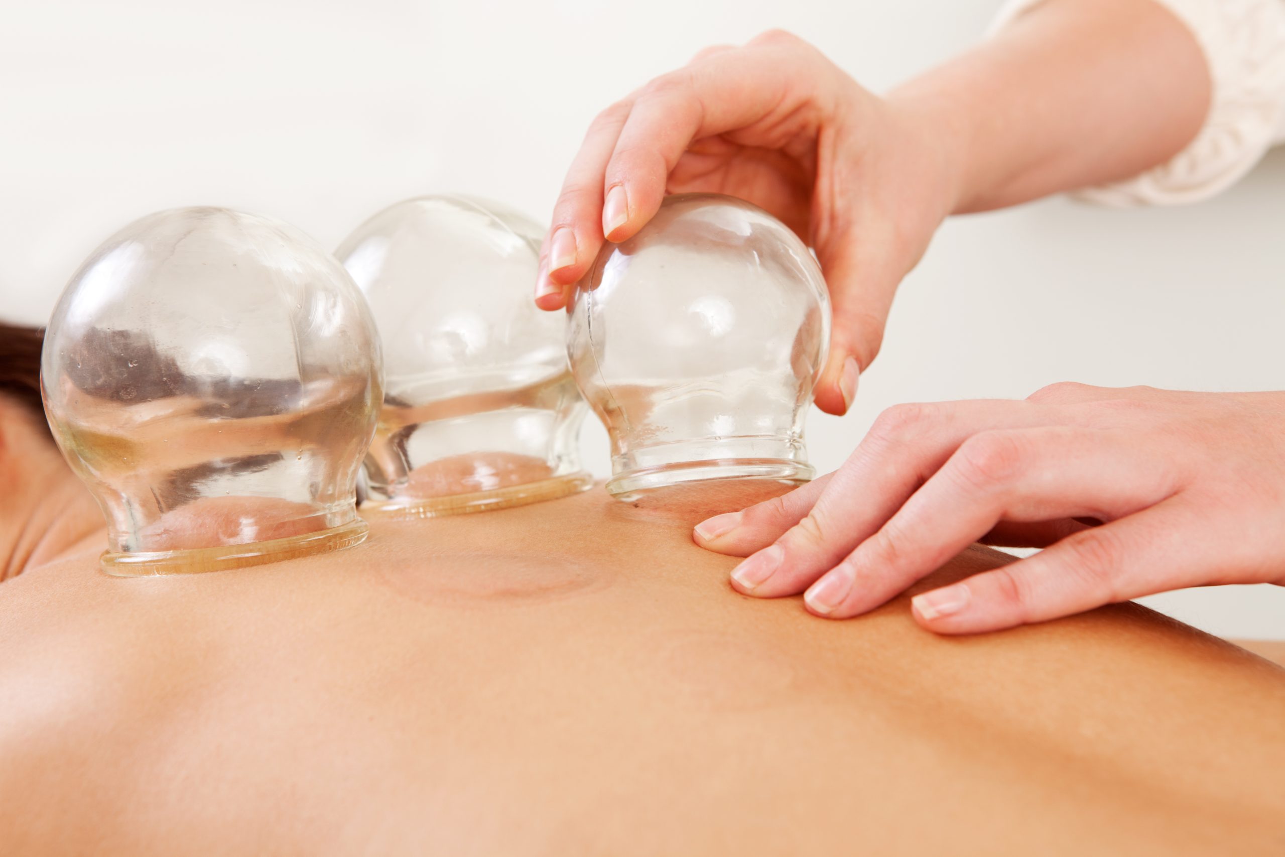 A person receiving cupping therapy, a practice from Chinese Medicine, on their back with a therapist's hands adjusting three glass cups.