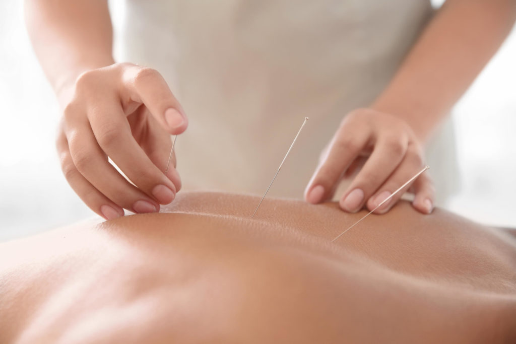 A close-up view of a person receiving Acupuncture treatment in NE Portland, Oregon, with several fine needles in their skin.